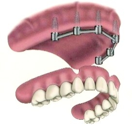 Alt På 4" tannimplantater Eksperter sammenligne Implantater med konvensjonelle broer